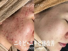 ルノン(Lunon)/肌質改善　《症例》