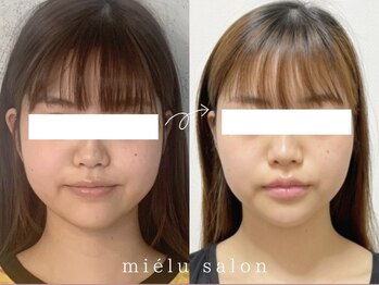 ミエル(mielu)/mielu式小顔矯正