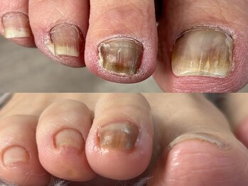 爪のいろは/諦める前に…フットケア♪