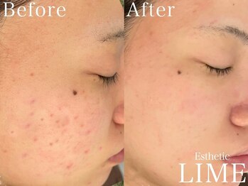 ベル 赤羽(Belle)/ハーブピーリング｜ニキビケア