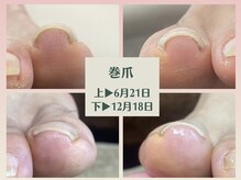 巻爪でお悩みのお客様も大歓迎です★矯正テープで簡単にケア♪