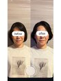 エルズ(L’s) フェイスラインの美容鍼後!