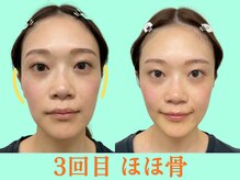ナチュラルパーフェクトフェイス 新宿/3回目・口下げ筋群改善/新宿小顔