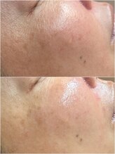 アウラ(Aula)/頬の赤みが気になる方