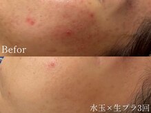 サロンヴェアリー 広尾(salon vary)/ニキビケア