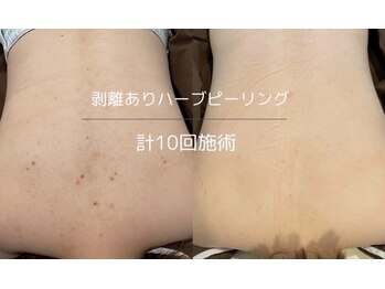 ライフサロン 別府(Life Salon)/ハーブピーリング/毛穴洗浄