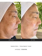 スキンラウンジ(SKIN LOUNGE)/韓国肌管理｜PDRN雪花ピール