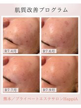 ハピア(HappiA)/Dr.PUR 肌質改善プログラム