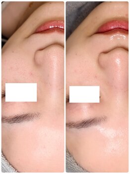 ペルル(Perle)/毛穴洗浄×ハーブピーリング