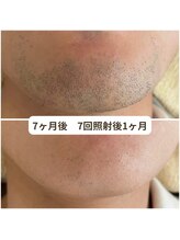 ビーボヌール(be-bonheur)/痛みの少ない肌管理ヒゲ脱毛
