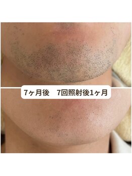 ビーボヌール(be-bonheur)/痛みの少ない肌管理ヒゲ脱毛