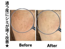 グレースティー 森町 箕面/施術の度にシミが薄く改善★