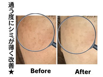 グレースティー 森町 箕面/施術の度にシミが薄く改善★