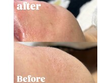 リエート(Lieto)/Wax脱毛