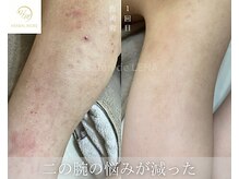 サロン ド レナ(Salon de LENA)/ハーブピーリング サロンドレナ