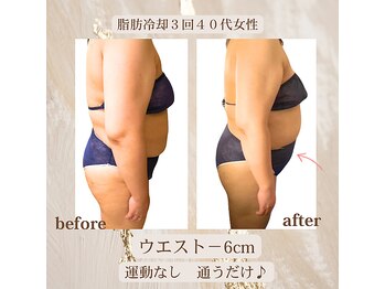 ラベージャ(La Bella)/脂肪冷却