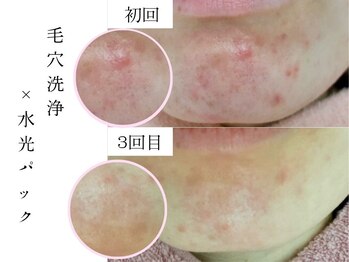 シェリー(Cheri)/繰り返すアゴニキビケア