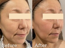 ココモンド(COCOMONDO)/幹細胞フェイシャル/エイジング