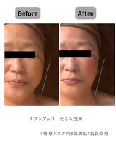 チャーム(Charm)/お悩み　たるみ　ほうれい線