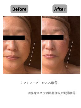 チャーム(Charm)/お悩み　たるみ　ほうれい線