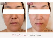 イル 名取店(iru)の雰囲気（リフトアップ/毛穴/脱毛/シミ/プラズマフェイシャル/小顔）
