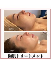 ラナン パラフューズ(Ranun's PARAFUSE.)/陶肌ビフォーアフター（1）