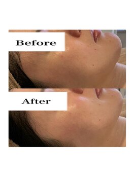 ライム 天神(LIME)/before&after トーンアップ！！