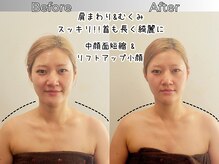 リストアハート(Restore Heart)/お顔をスッキリ