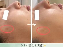 こもれび/1回の施術