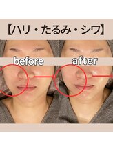 モーイエンチャーム(mooi en charme)/【たるみ・ほうれい線part1