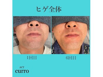 アクト クロ(ACT curro)/【ヒゲ全体】脱毛施術例