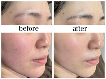 アリエス/ハイドラ×顔脱毛１回の変化