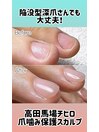 陥没した爪でもOK!保護ネイル