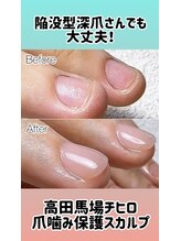 チヒロネイル/陥没した爪でもOK!保護ネイル