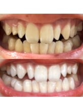 ハク 南船橋店(HAKU)/☆ホワイトニング☆事例写真７