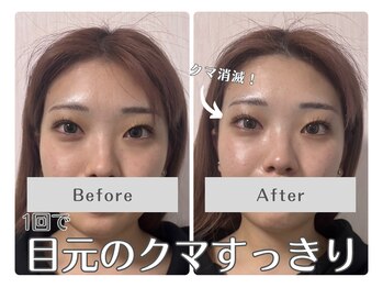 ルリアン(Lurian)/エステ1回でのBefore→After