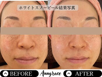 アングレイス(Anngrace)/【本気の肌質改善!】圧倒的効果