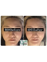 キュープ 小顔美容矯正専門サロン 横浜店(Qpu)/小顔矯正4回の変化