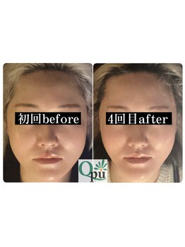 キュープ 小顔美容矯正専門サロン 横浜店(Qpu)/小顔矯正4回の変化
