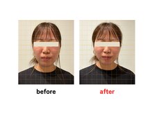 四条大宮アシスト鍼灸整骨院/美容鍼ビフォーアフター