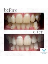 ホワイトニングショップ 広島店(WHITENING SHOP)/【ホワイトニング】Before After
