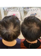 アイスブルー(Ice blue)/プロセルセラピーズBefore/After