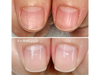 シュガーズネイル(sugar's nail)/自爪育成3ヶ月コース