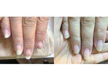 リモナ(Rimona)の写真/《美爪育成サロン》薄い爪、爪が小さい、割れやすい等お悩みご相談ください♪悩んでいた爪が魅力に変わる☆