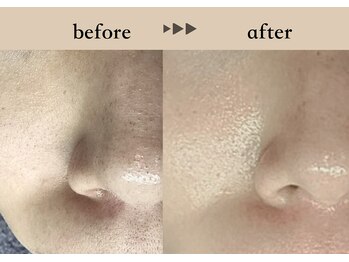 ソーヴ(SOLVE)/1回 Before→after/マツヤニWax