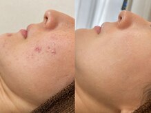 アエオボンヌール(A.E.O BONHEUR)の雰囲気（ニキビは身体からのSOS！体質から整えるニキビ改善）