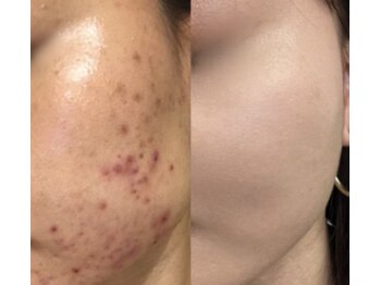 サロンドココ(Salon de coco)の写真/人気No.1ハーブリプロ！繰り返す肌荒れや、ニキビにお悩みの方◎・毛穴・シミ・たるみなど、全てのお悩みに