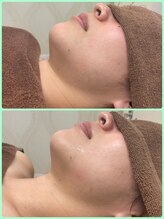 シャラ(SHARA)/【5D超音波】小顔、リフトアップ