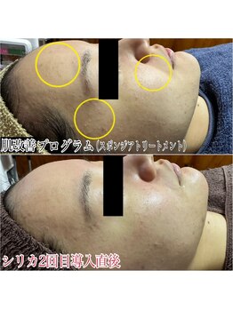 エステルーム クリスタル/【肌改善プログラム】ピーリング