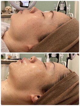 ルノン(LUNON)/肌改善コース　10回以上　50代